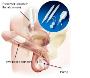 penile implant for erectile dysfunction